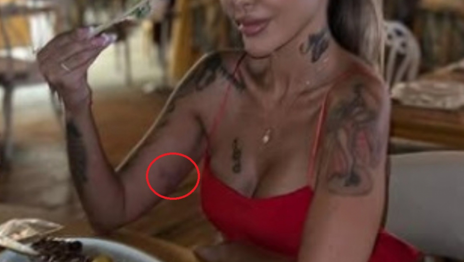 Aneli Ahmić modrice