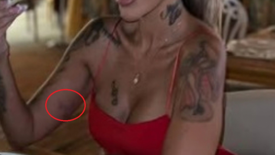 Aneli Ahmić modrice