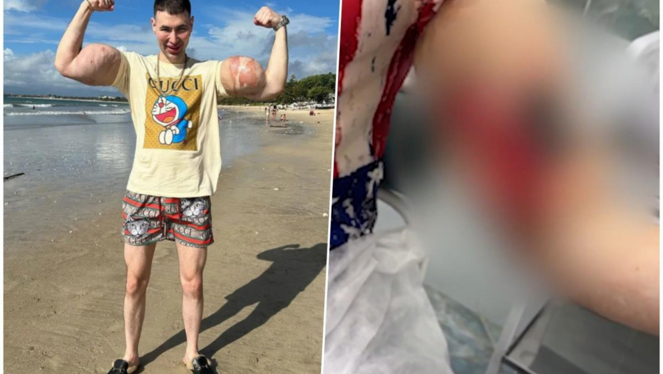 Influenser sa bicepsima