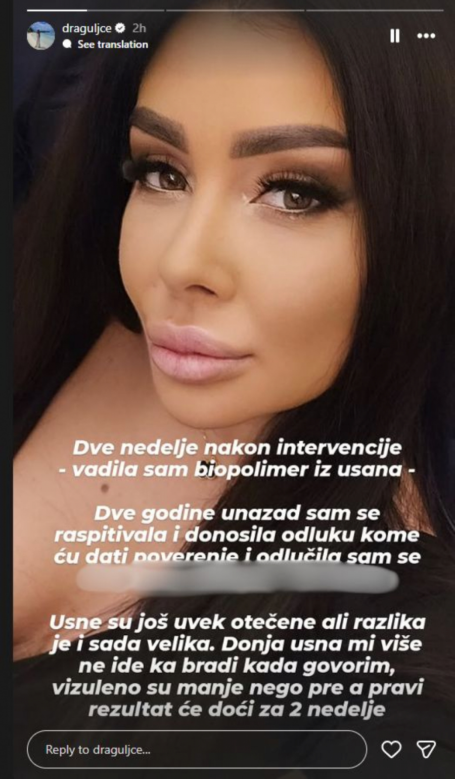 GASTOZOVA BIVŠA OTIŠLA POD NOŽ Zorica Dukić rešila dugogodišnji problem, odmah pokazala rezultate (FOTO)