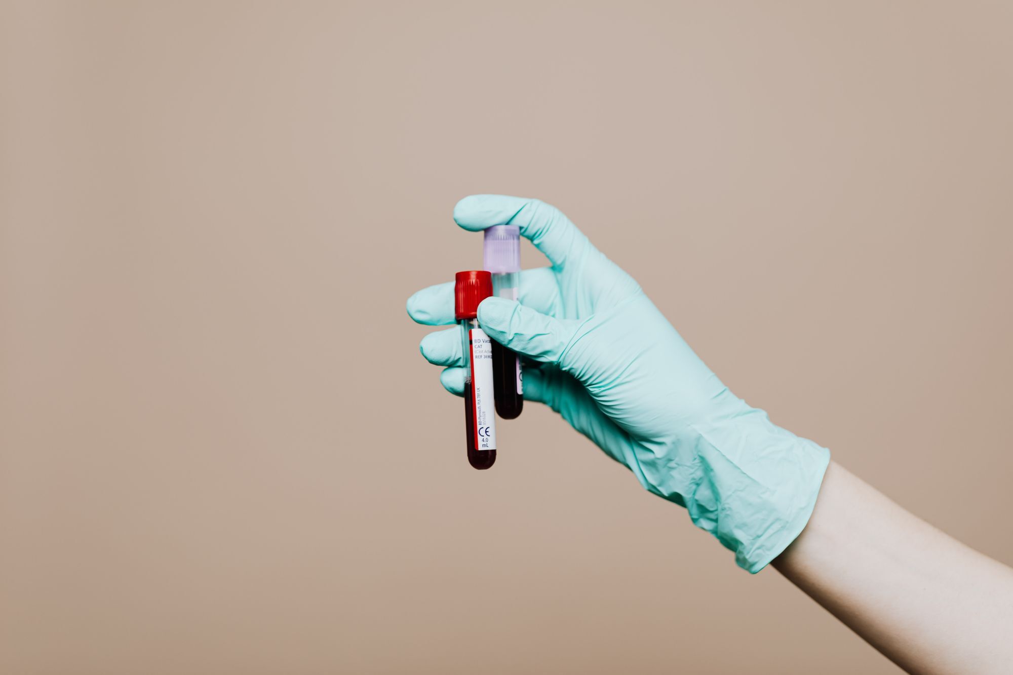 Test na BRCA gene radi se iz uzorka krvi i pokazuje da li osoba nosi naslednu mutaciju Test na BRCA gene radi se iz uzorka krvi i pokazuje da li osoba nosi naslednu mutaciju