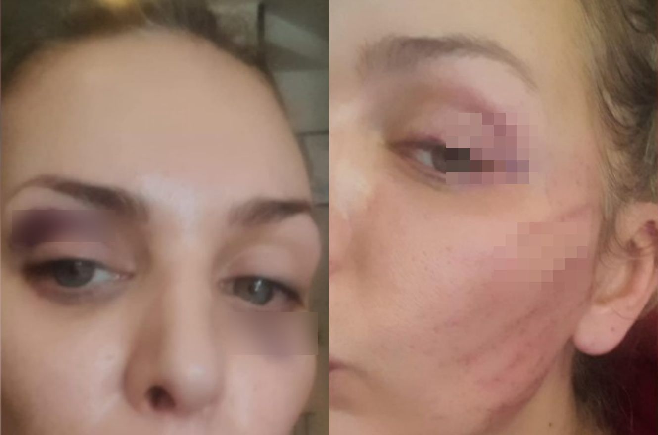 Ava Karabatić pretučena Ava Karabatić pretučena