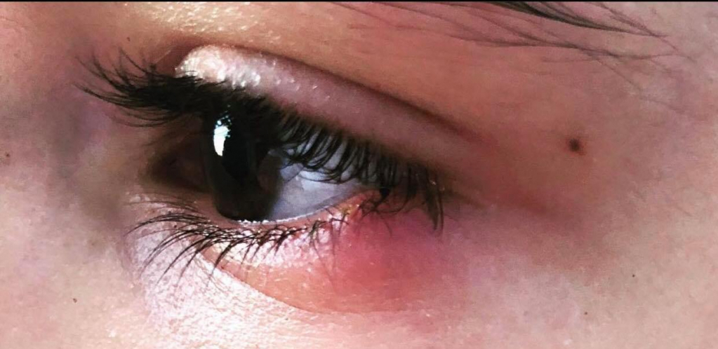 ČMIČAK NA OKU: Evo kako da izlečite svrab, crvenilo i nelagodnost