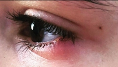 ČMIČAK NA OKU: Evo kako da izlečite svrab, crvenilo i nelagodnost