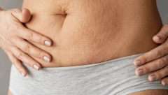 NISU SVI DELOTVORNI: Da biste videli rezultate, neophodno je da gel protiv strija sadrži ove sastojke