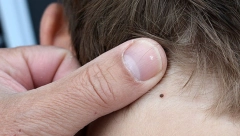 POČELO JE ZAPRAŠIVANJE KRPELJA Evo za koga otrov takođe može biti poguban!