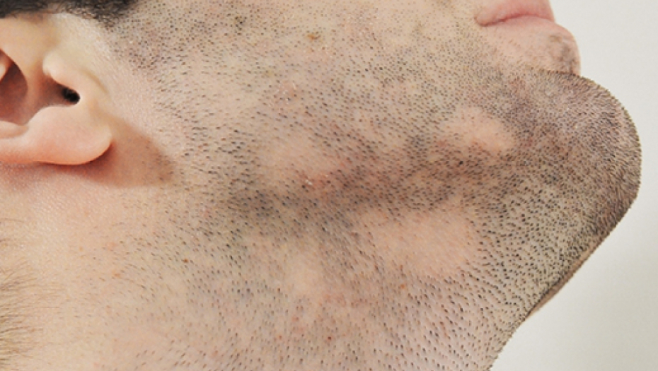 KARCINOM KOŽE JAVLJA SE NAJČEŠĆE NA 2 MESTA: Simptomi nisu samo na telu, neki liče i na koronu