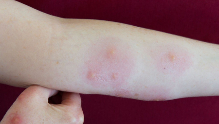 OVU KRVNU GRUPU KOMARCI OBOŽAVAJU Još ako pijete ovo piće, ima da vas urnišu