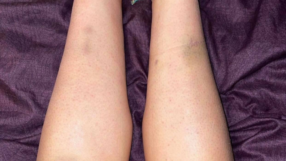 SIMPTOMI RAKA SRCA VIDE SE NA NOGAMA Kad se pojave ovi signali, obično bude suviše kasno