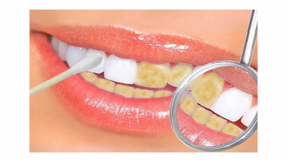 NE BACAJTE PARE Ispirajte zube ovim sastojkom i posmatrajte kako postaju beli