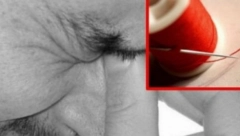 ISPRAVKA: Nema dokaza da tretman iglom pomaže u slučaju moždanog udara