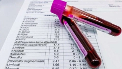 SAČUVAJTE OVAJ TEKST! PROTUMAČITE SAMI KRVNU SLIKU: Evo šta znače skraćenice i na šta njihove vrednosti upućuju