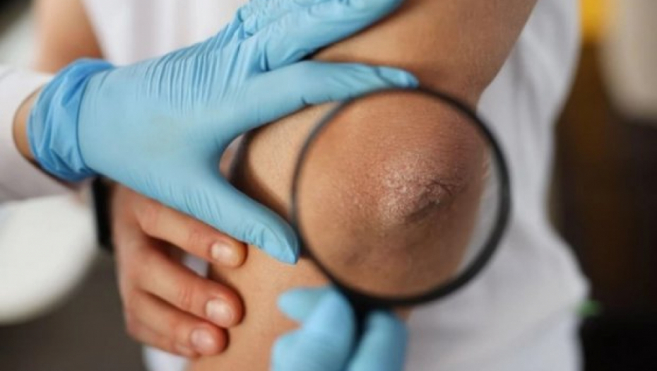 DA LI IMATE SIVU, ISPUCALU KOŽU NA LAKTOVIMA? Ovaj simptom ne smete zanemariti, odmah kod lekara