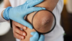 DA LI IMATE SIVU, ISPUCALU KOŽU NA LAKTOVIMA? Ovaj simptom ne smete zanemariti, odmah kod lekara