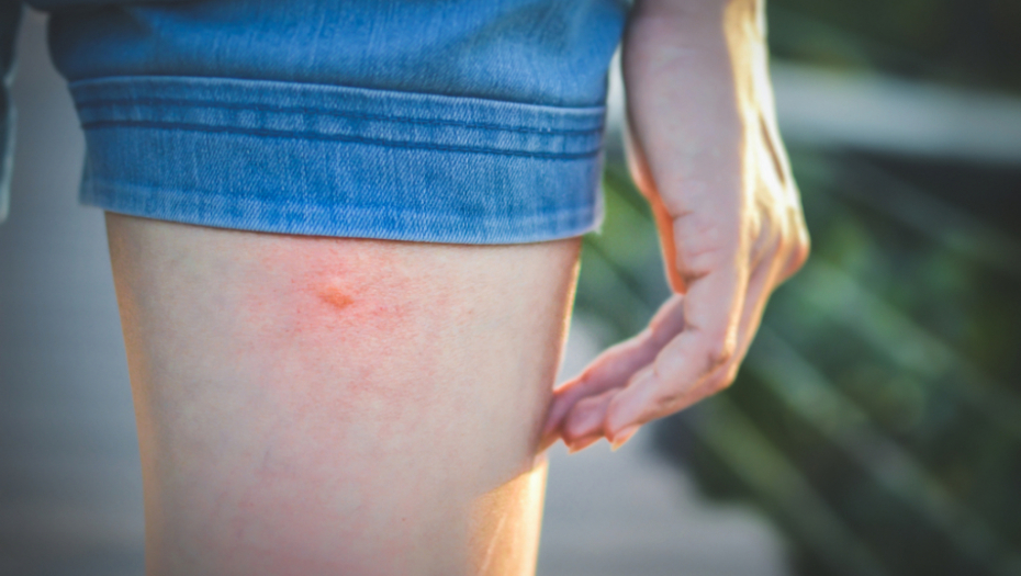 Prirodno rešenje: Napravite lek koji će smanjiti otok nakon ujeda ineskta