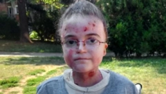 Anu boli svaki dodir, ali naša pomoć ublažiće njene muke: Pomažu samo specijalne gaze i stalna nega