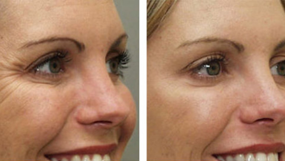 KOŠTA 50 DINARA, A IMA EFEKAT BOTOKSA Posle 12 dana ova maska briše bore i vraća mladelački sjaj