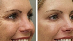 NAŠE BAKE SU KORISTILE 1 SASTOJAK ZA ZATEZANJE LICA Uklanja bore i čini kožu zdravom i glatkom!