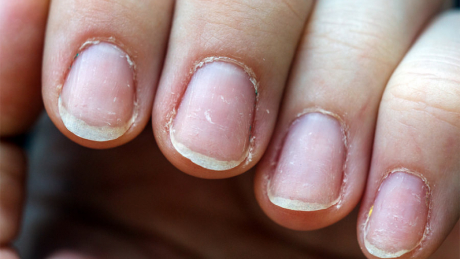 Iskoristite prirodne sastojke za negu: Oporavite lomljive nokte namirnicama iz vaše kuhinje