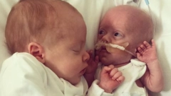 PRERANO ROĐENI DEČAK SE BORI ZA ŽIVOT: Zastaće vam dah kad vidite šta njegov brat blizanac radi za njega