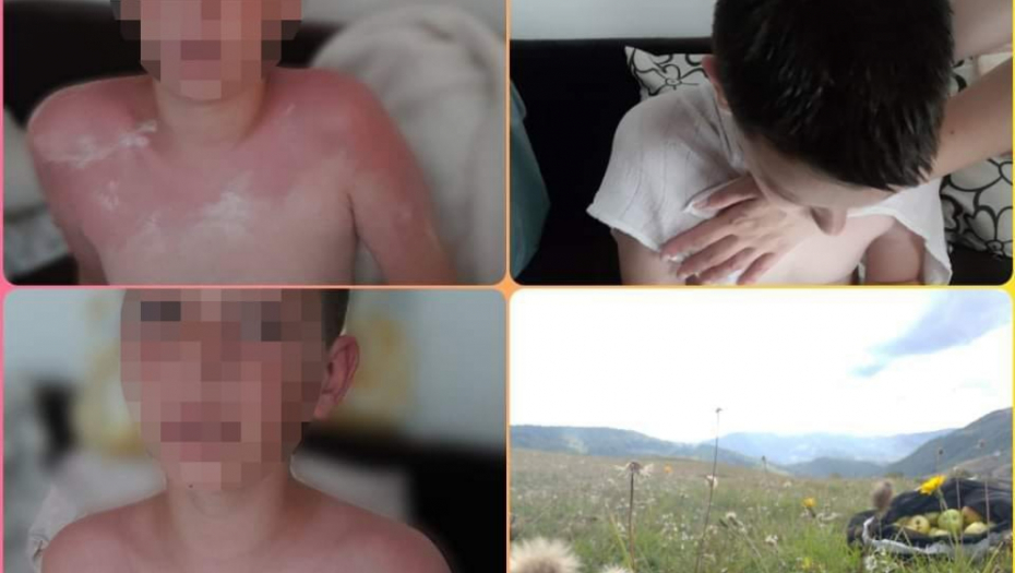 SIRĆE OD PLANINSKE DIVLJE JABUKE Opekotine na koži nestaju za 10 minuta, kao rukom odnete