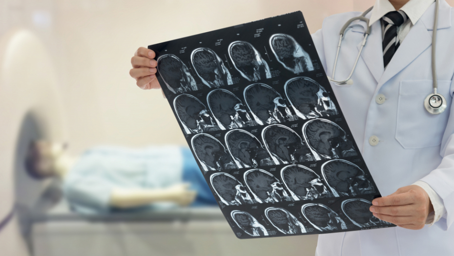 ŽENI IZ MOZGA IZVADILI ŽIVOG CRVA Lečila se od depresije, lekari zapanjeni "bio je okrugao"