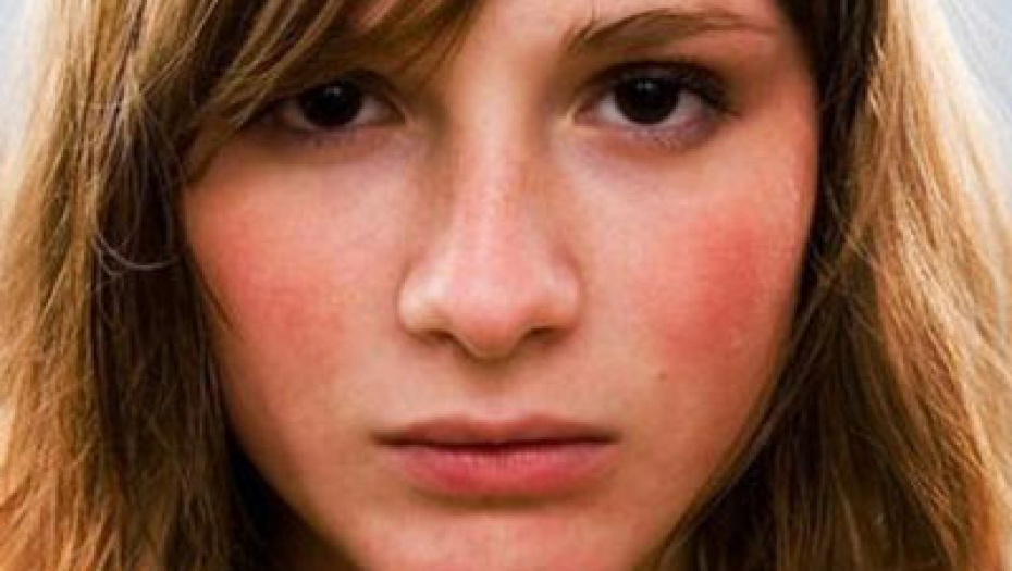 AKO PRIMETITE OVO NA KOŽI, ODMAH URADITE KRVNU SLIKU I lekari ga često zamene za običan osip, a znak je teške bolesti