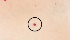 DA LI IMATE OVE CRVENE TAČKICE PO TELU? Najčešće su bezopasne, ali mogu da ukažu i na loše stanje jednog bitnog organa!