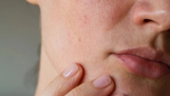 RAK PLUĆA MOŽE SE VIDETI I NA LICU Ako primetite ovo kada se PROBUDITE, odmah idite kod lekara