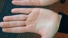 POSMATRAJTE SVOJE DLANOVE Ako su crveni, to može da bude simptom ozbiljne bolesti