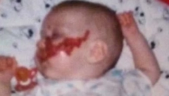 RODILA SE SA MRLJOM PREKO POLA LICA: "Tata kada me video, vrišteći je izleteo iz sobe", ona danas ima 25 godina i ovako izgleda