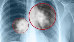 ŠTA SE DEŠAVA SA PLUĆIMA NAKON PRELEŽANE KORONE: Dr Marković objašnjava koje posledice ostavlja na druge organe