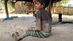 DEVOJČICA (7) SE PRETVARA U KAMEN Boluje od izuzetno retke bolesti, a svaki dan koji osvane za nju i više nego mučan (UZNEMIRUJUĆE FOTOGRAFIJE)