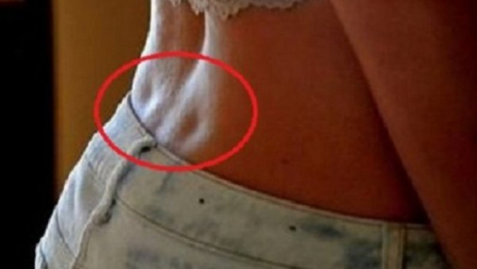 AKO IMATE OVE 2 RUPICE NA LEĐIMA, PRAVI STE SREĆNICI Evo šta ova fizička karakteristika govori o vama