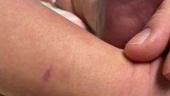 NA BEBI JE UOČILA NEOBIČNU MRLJU Nije ni slutila da je ovo bio simptom smrtonosne bolesti!