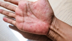 OBRATITE PAŽNJU NA SVOJE DLANOVE Ako ovo primetite, trebalo bi momentalno da postetite doktora!