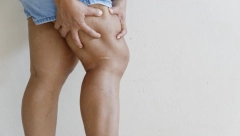 OVO JE STVAR KOJA NAS BUKVALNO SVE PLAŠI Kako da znamo da li imamo krvni ugrušak?