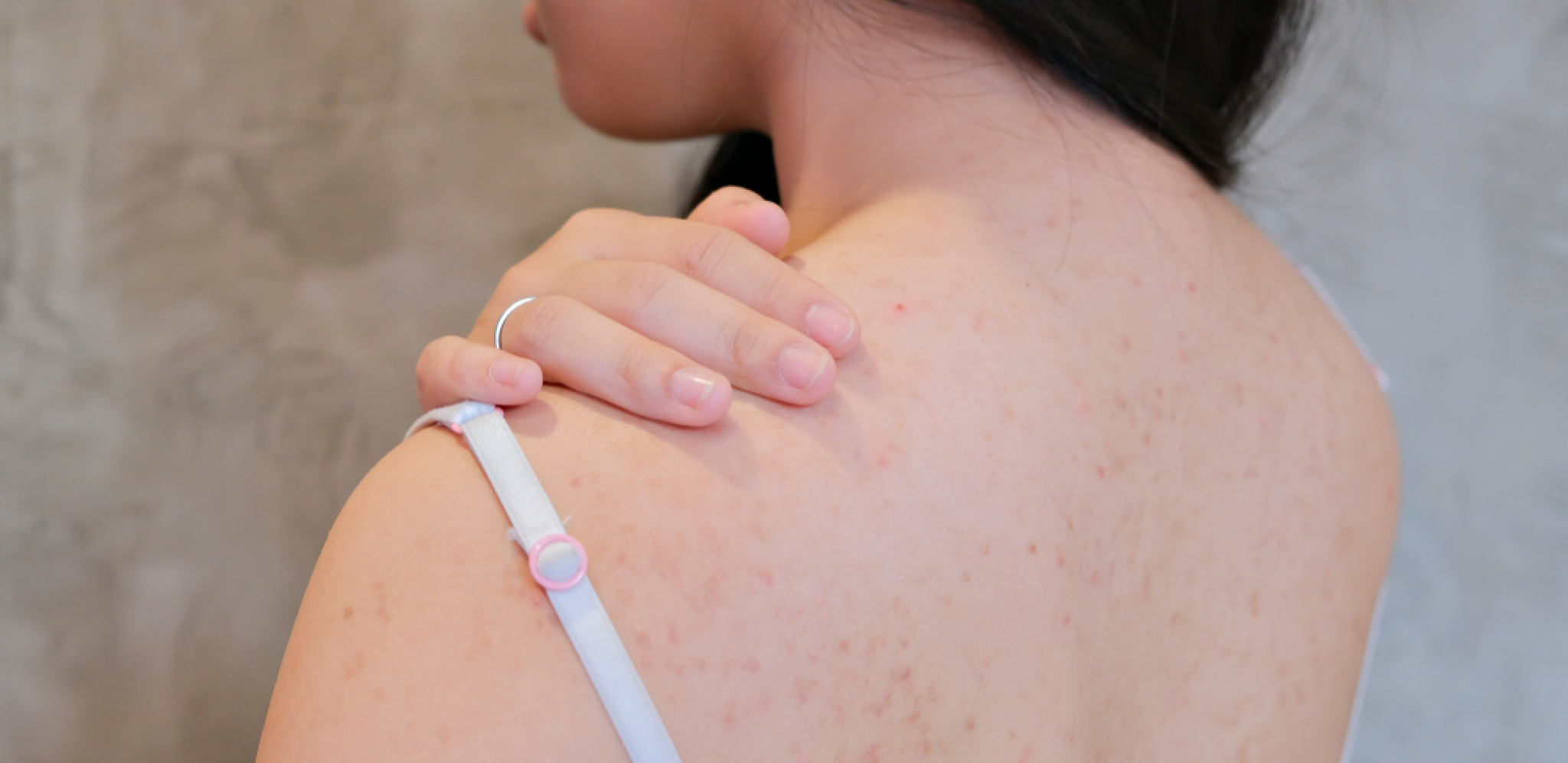 Akne na leđima: Zašto nastaju i kako se leče?