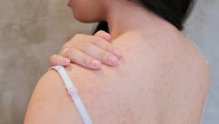 Akne na leđima: Zašto nastaju i kako se leče?