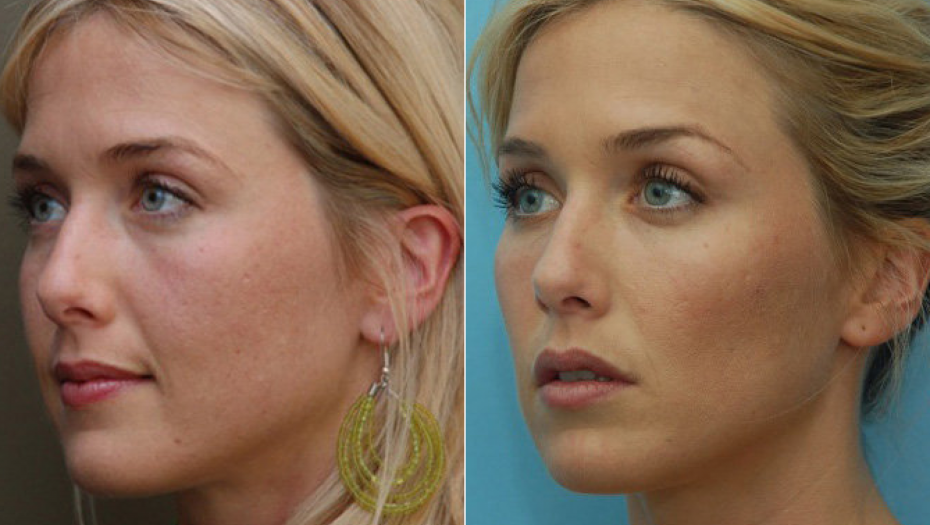 ZA BLISTAV I ZDRAV TEN Maska od 2 sastojka pegla fine bore preko noći