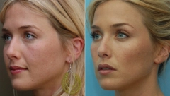 NAMIRNICE KOJE ODLAŽU STARENJE Zatežu kožu bolje od liftinga, a lice postaje zdravo i mlado