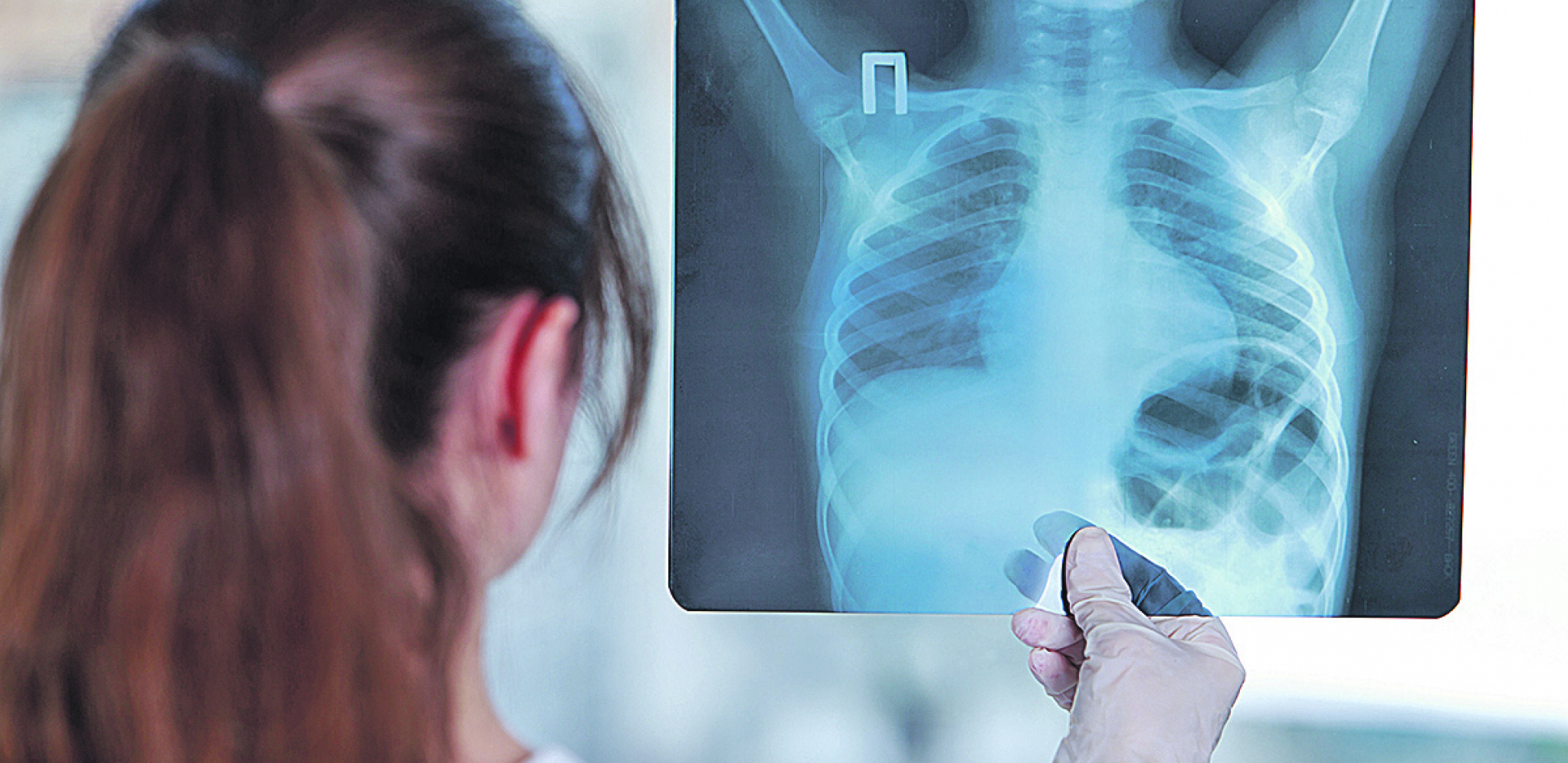 DA BI SPREČILI POSLEDICE Obavezni pregledi posle korone