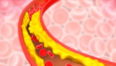LOŠA ISHRANA NIJE JEDINI KRIVAC Evo šta sve može prouzrokovati holesterol u krvi