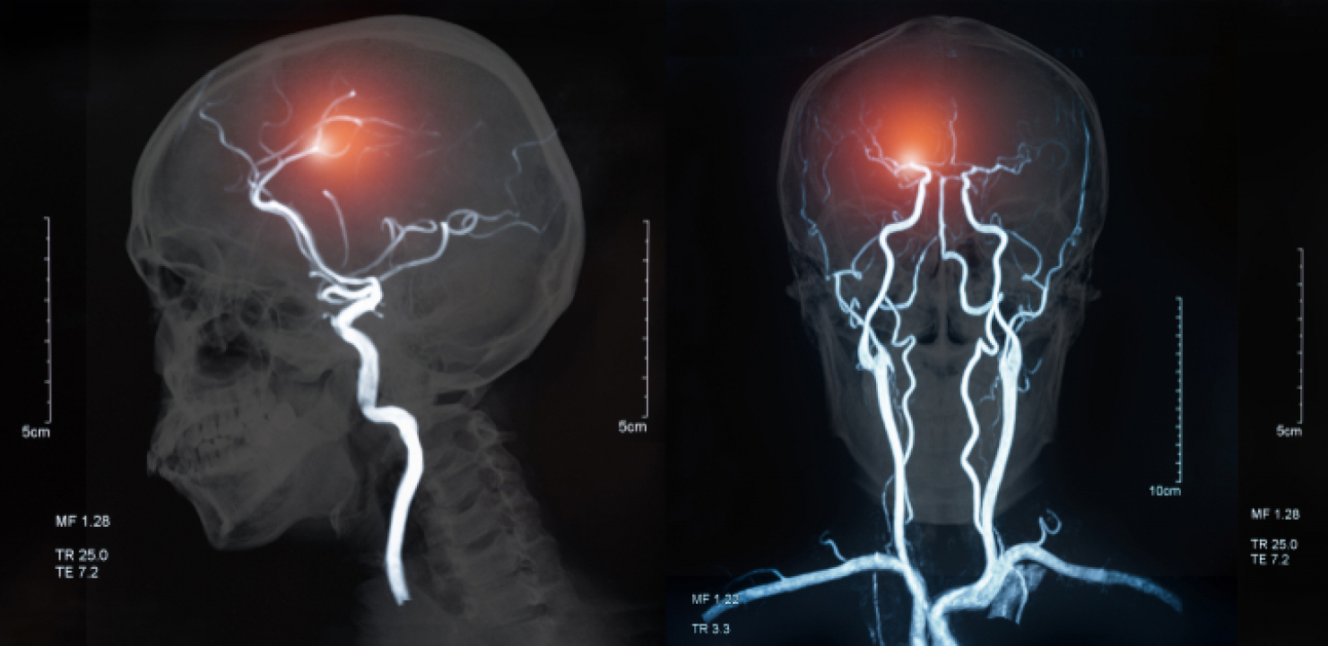 DA NEMA TOGA, DANAS NE BIH BILA ŽIVA Potresna ispovest žene kojoj su ugradili pejsmejker u mozak kao eksperimantalnu terapiju