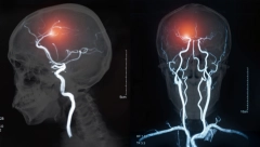 TREĆINA SRPSKOG STANOVNIŠTVA OD NJEGA UMIRE: Ako u prva tri sata osetite simptome - preživećete od moždanog udara