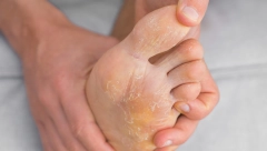 PRAVI SPAS OD ISPUCALE I SUVE KOŽE NA STOPALIMA: Namazala sam jedan sastojak na grube pete i ostala u čudu, noge su mi bile premekane