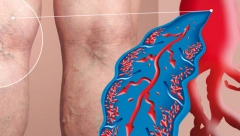 TRADICIONALNA RUSKA KAŠA RAZBIJA TROMB Tvrde da je spas za proširene vene, ništa ne deluje tako dobro!