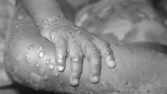 SMRTONOSNA ZARAZA Srbija je zbog ovog virusa 2018. godine pojačala nadzor na granicama, a sada je registrovan u Velikoj Britaniji (FOTO)