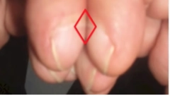 TEST OD PAR SEKUNDI OTKRIVA STANJE VAŠIH PLUĆA Položaj nokta može da ukazuje na kancer, ali i na druge smrtonosne bolesti!