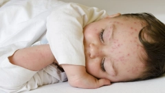 MAJMUNSKE BOGINJE SU STIGLE U EVROPU: Simptomi prvo liče na grip, ali mogu biti fatalni, pažljivo pratite promene